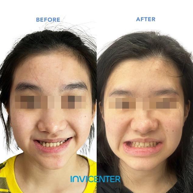 Underbite3