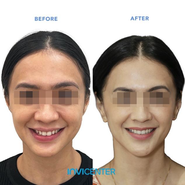 Keseimbangan Proporsi Wajah (Facial Symmetry)