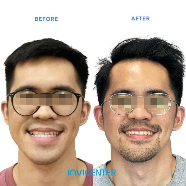 Underbite4
