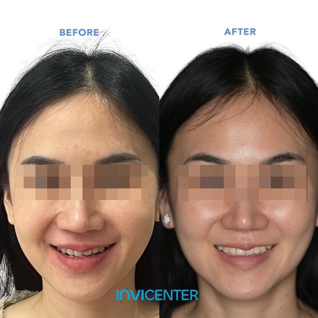 Rahang Bawah Maju (Underbite)