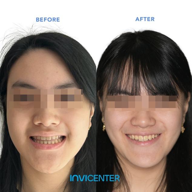 Rahang Bawah Maju (Underbite)