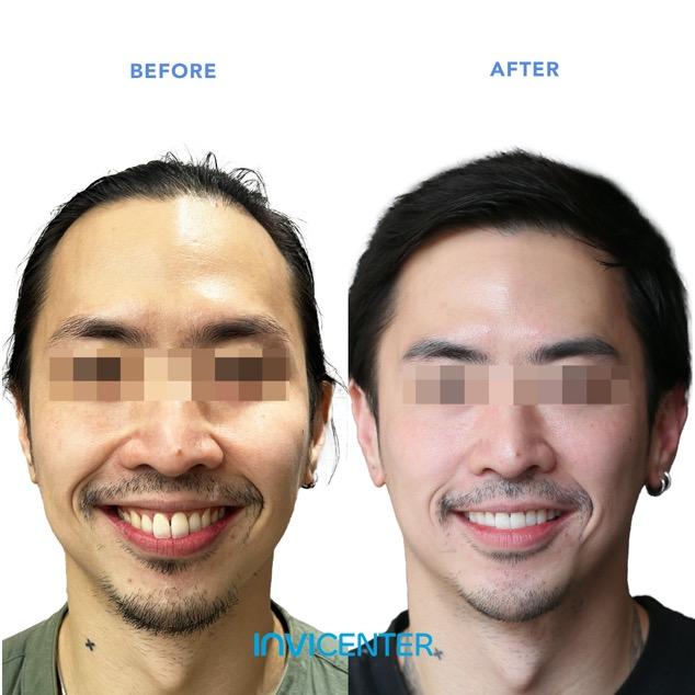 Koreksi Gigi Maju (Overbite)