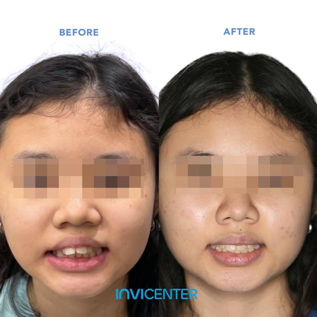 Intervensi Ortodonti Anak (Invisalign First) & Remaja (Invisalign Teen)